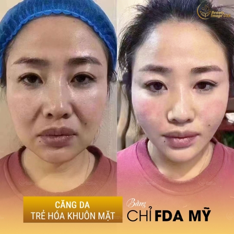 Album căng chỉ