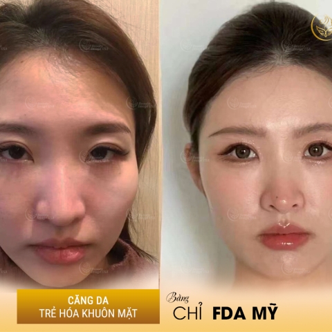 Album căng chỉ