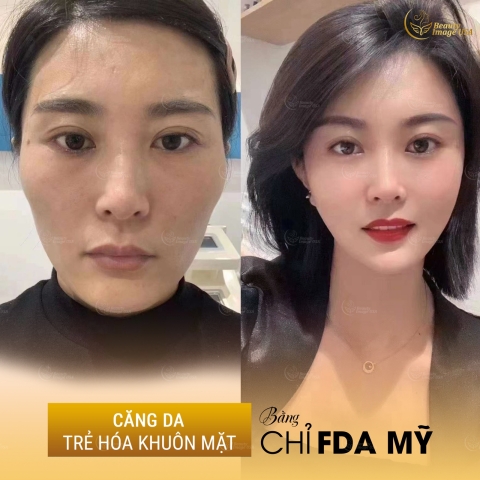 Album căng chỉ