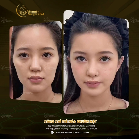 Album căng chỉ