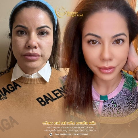 Album căng chỉ
