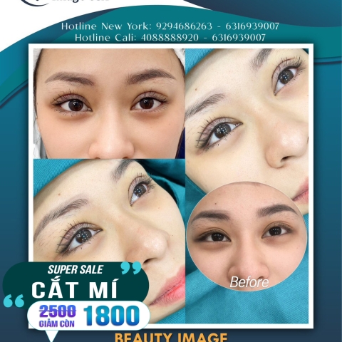 Hình Ảnh Cắt Mí