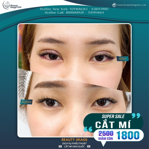 Hình Ảnh Cắt Mí