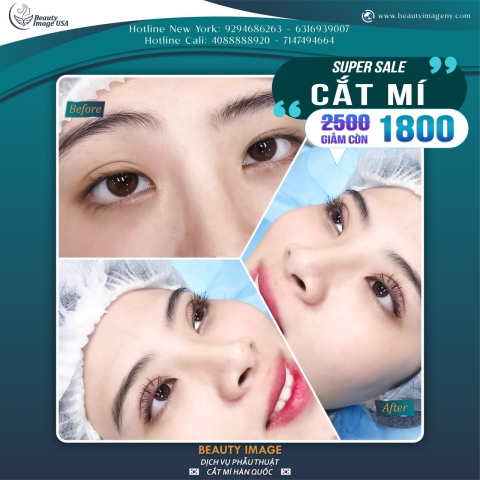 Hình Ảnh Cắt Mí