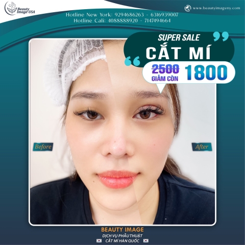 Hình Ảnh Cắt Mí