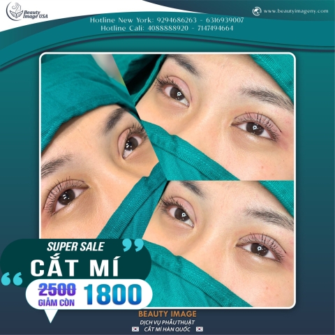 Hình Ảnh Cắt Mí