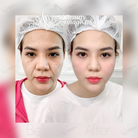 Album căng chỉ